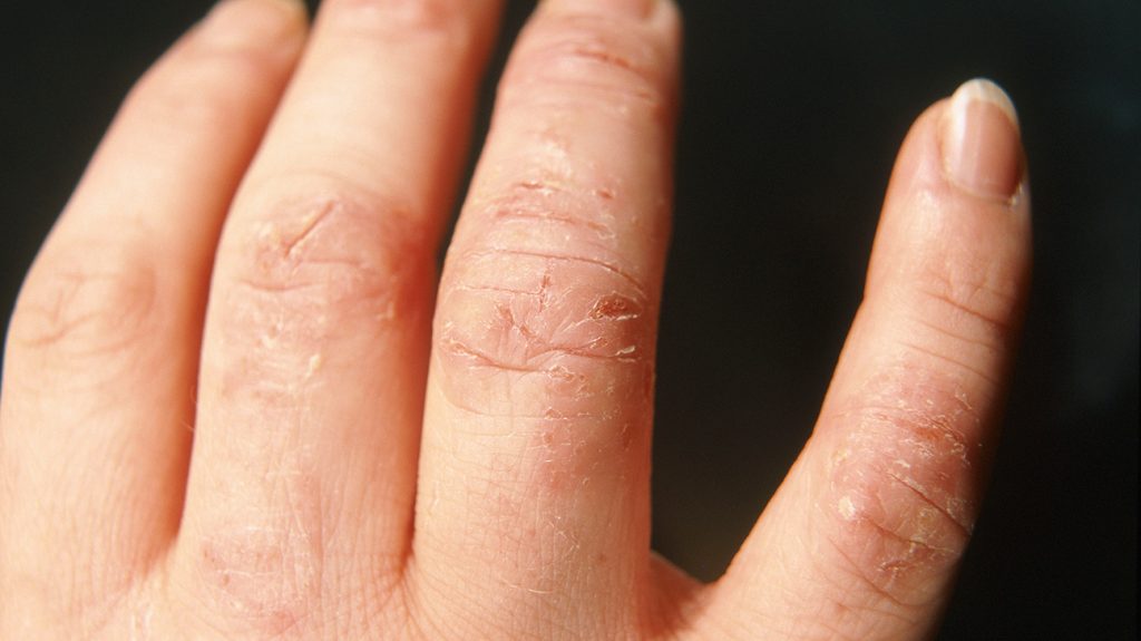 Knowing the unique types of eczema on hands