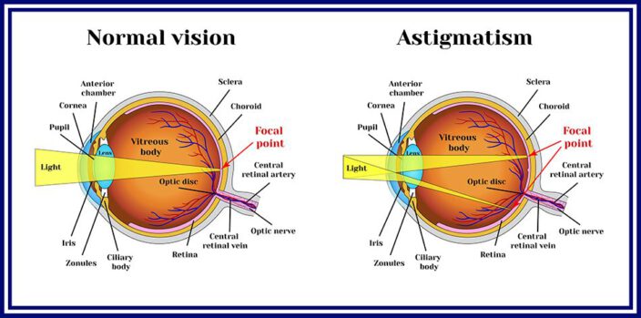 How Orthokeratology Functions and Possible Risks