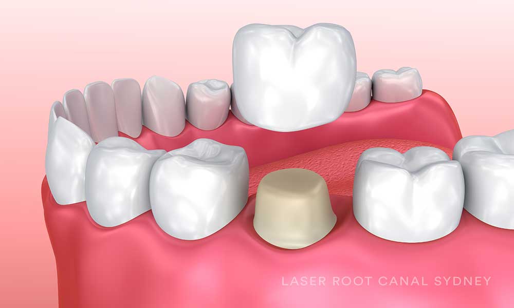 dental crown after root canal therapy